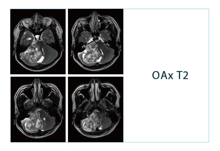 【朗润影像档案】磁共振影像病例分享(编号20180831)