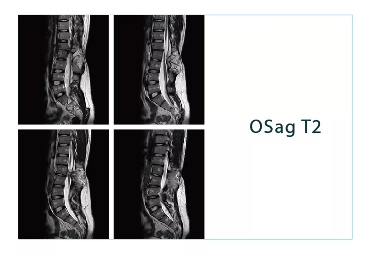 【朗润影像档案】磁共振影像病例分享(编号20180907)